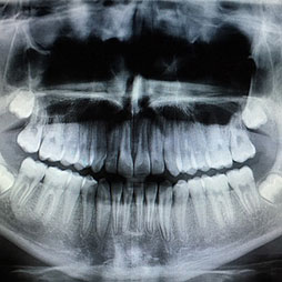 Radiographie dentaire